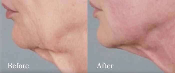 Ultherapy (Immediate Post-Treatment)